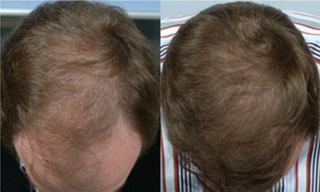 Male Hair Loss NYC - (212) 644-6454 - NYC Male Hair Loss - New York, NY