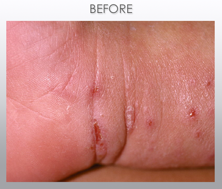Expert Scabies Treatment at 629 Park Avenue, NYC