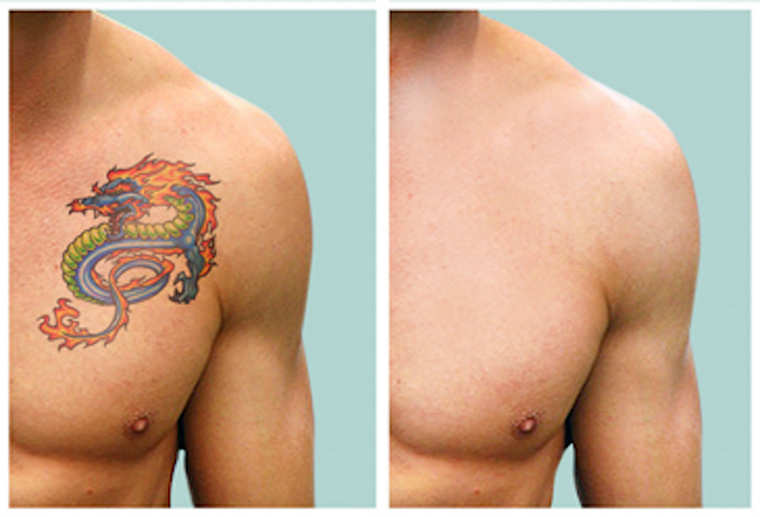 7. Clean Slate Laser Tattoo Removal - wide 8